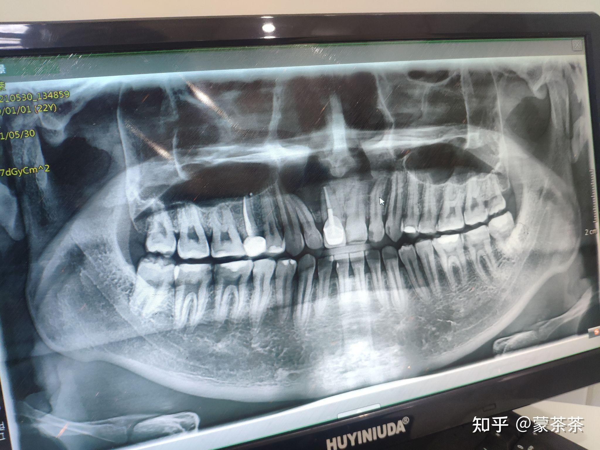 3) 第一磨牙异位萌出的治疗-口腔科学-医学