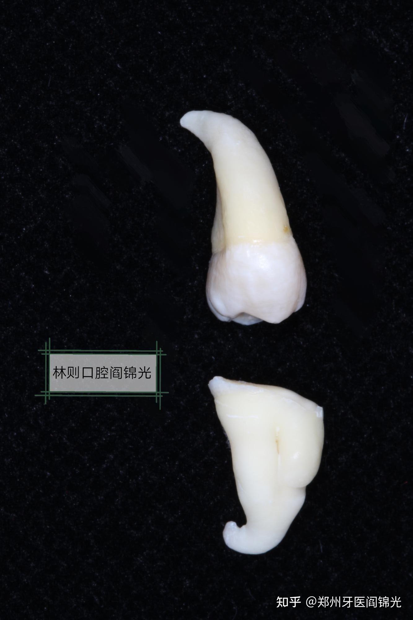 拔除牙根弯曲的智齿