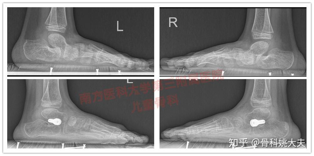 指任何骨,韌帶肌肉生理異常,導致足內則,外則縱弓和橫弓出現塌陷或