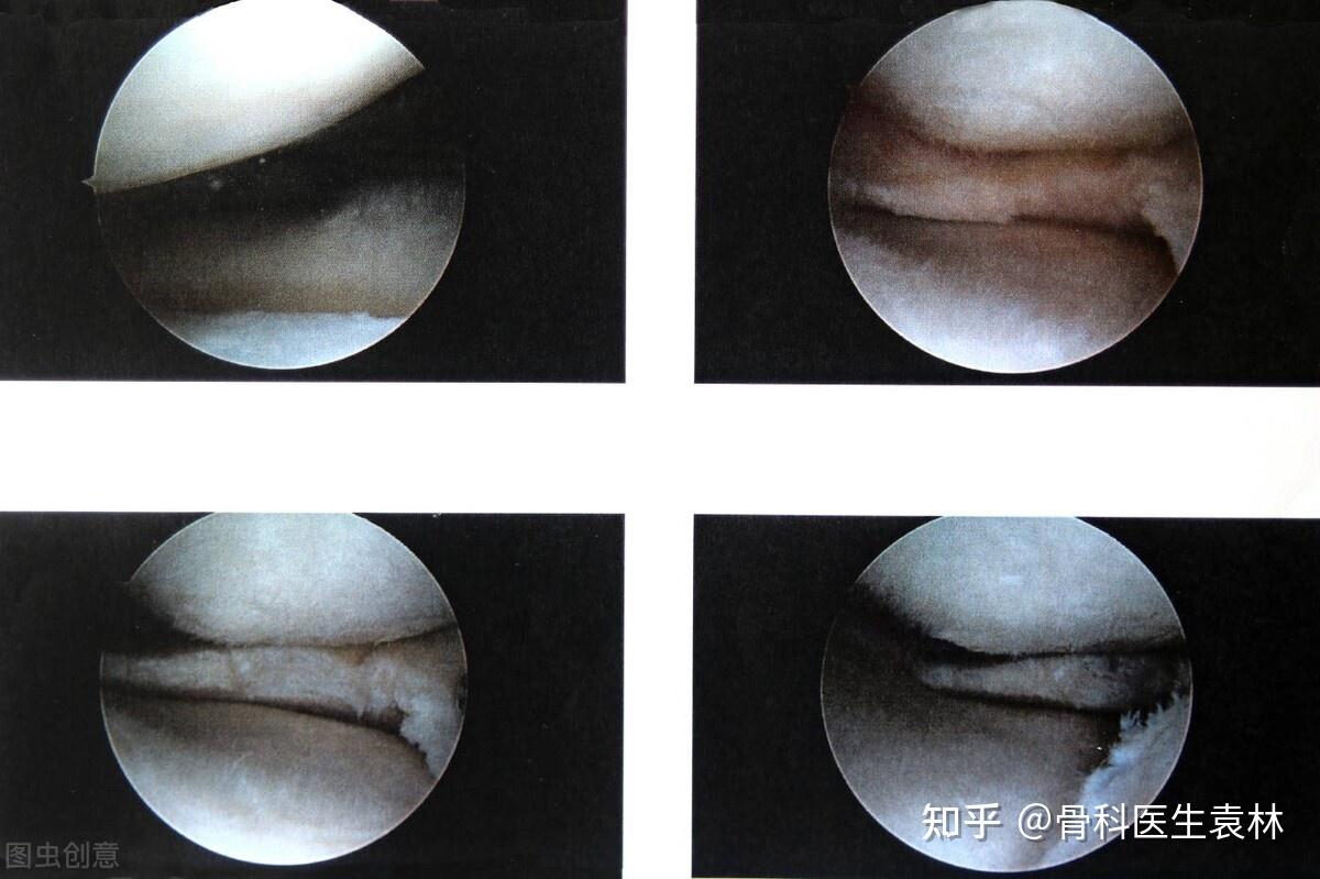 半月板縫合手術後多久可以正常走路