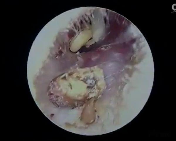 的硬物一般可用吸引器吸出或水冲洗取出,泡的发胀的,可以用耵聍钩钩取