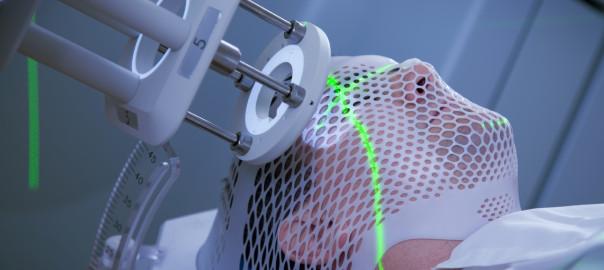 科普解读:放疗引起的放射性脑损伤