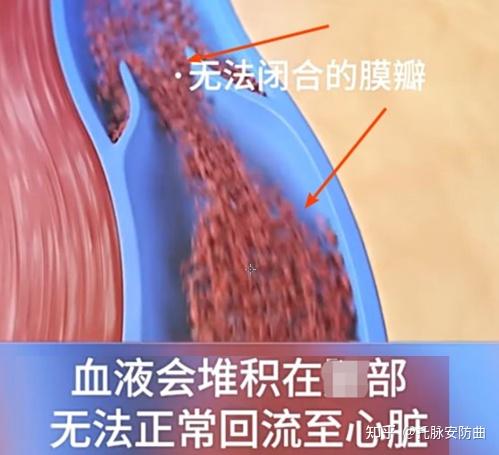 精索静脉曲张是什么原因引起? - 知乎