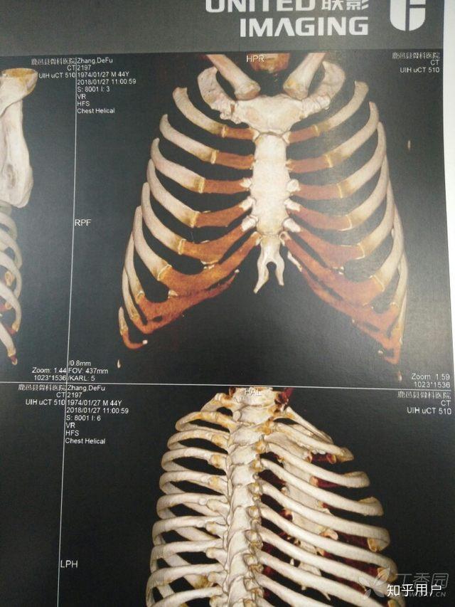 胸骨剑突是怎么回事? - 知乎