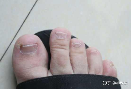 灰指甲是什么 知乎