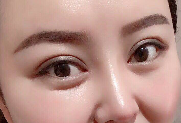 什么样的双眼皮形状最好看目前流行哪种双眼皮形态