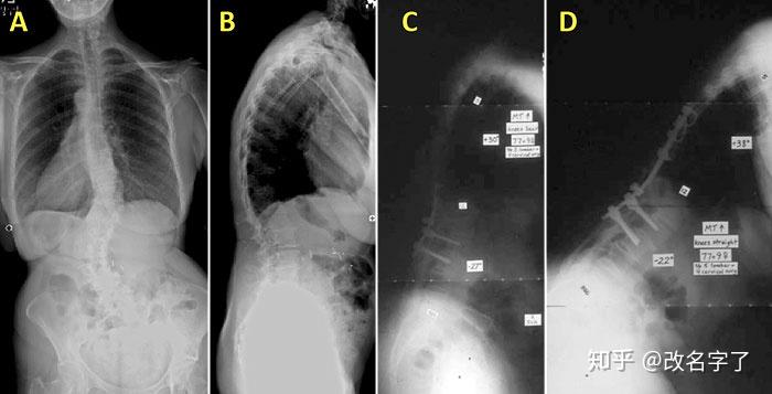 成人特发性脊柱侧弯