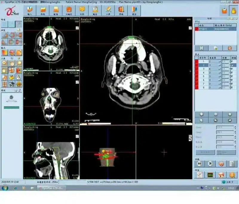 医案日记上颚癌患者住院10天瘤体缩小明显