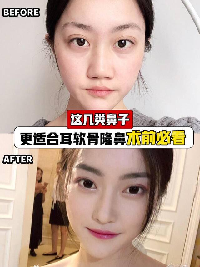 这几类鼻子更适合耳软骨隆鼻