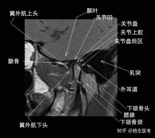 详细解剖示意图——助你理解颞下颌关节 - 知乎
