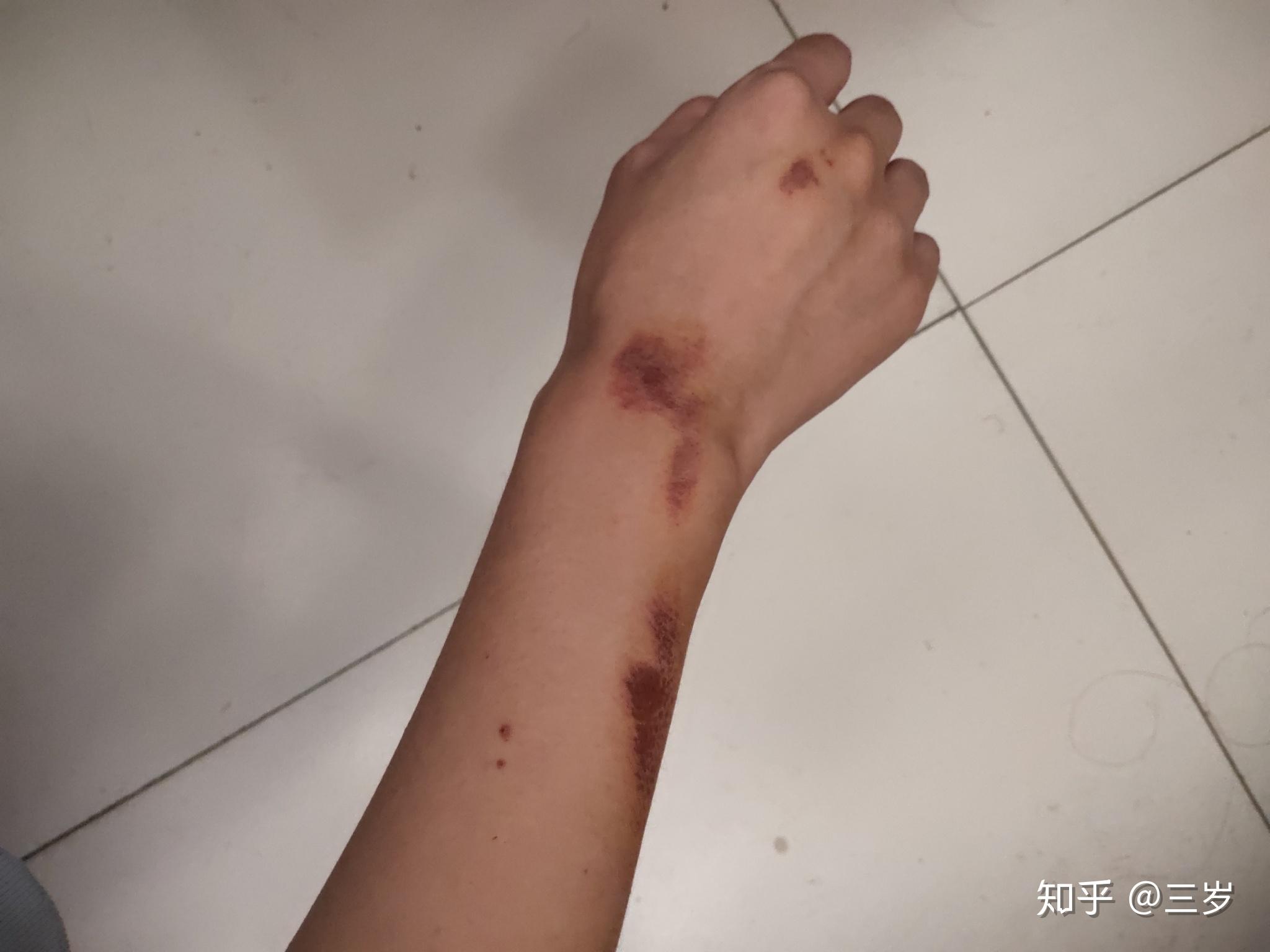 记录擦伤 - 知乎