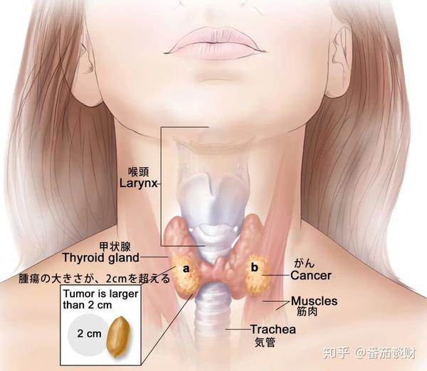 90 的甲状腺结节患者也能购买的医疗保险 知乎