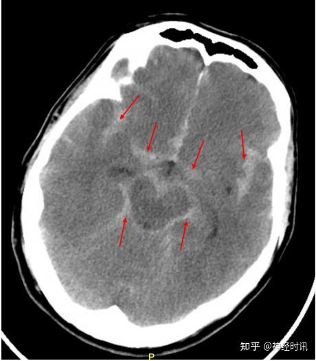 图1 ct提示头蛛网膜下腔出血表 3 ottawa 蛛网膜下腔出血规则perry