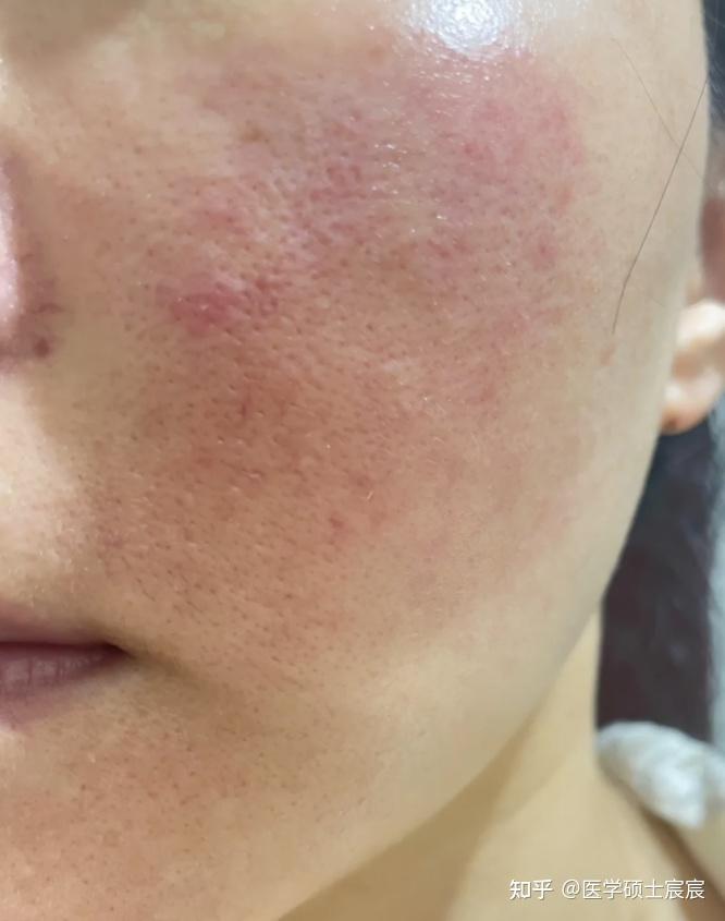 当你皮肤敏感,脸颊泛红干痒,外油内干,看完这篇彻底解决你的皮肤