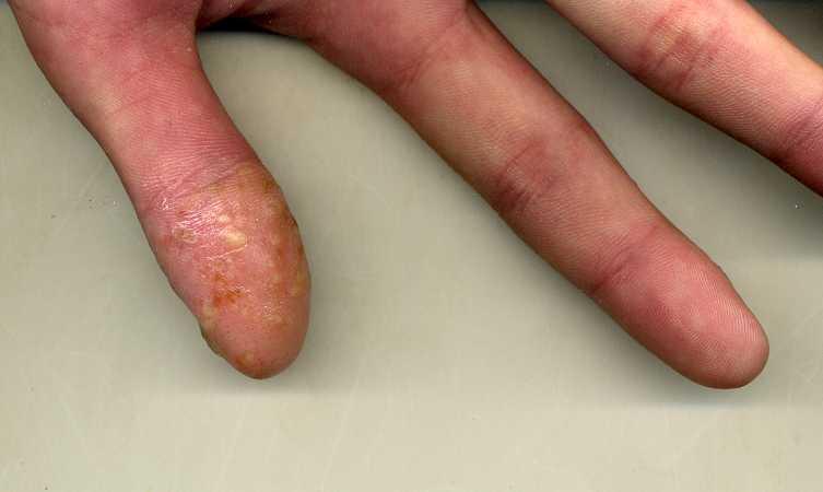 手真菌感染 早期图片