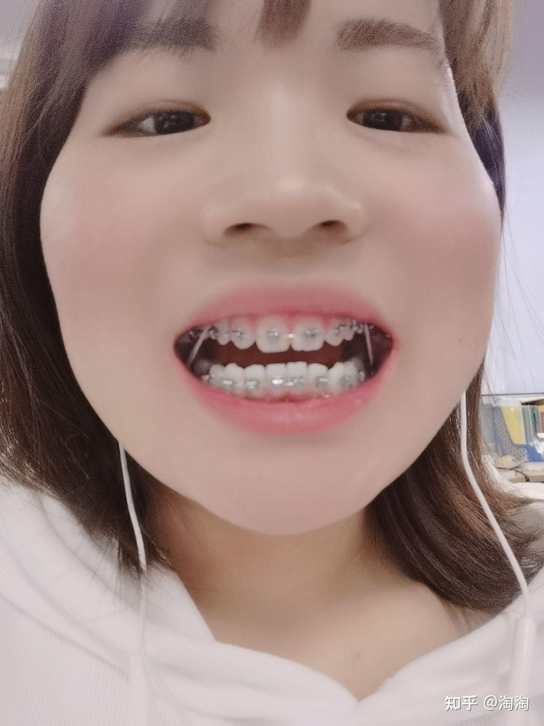 牙齿矫正戴像皮筋 - 知乎