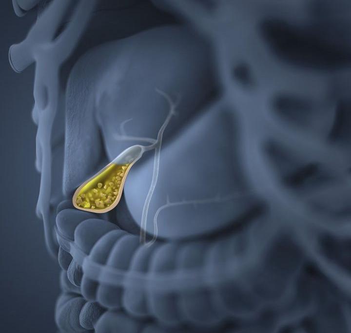 有胆囊炎,多发胆结石的人疼痛过后还会再复发吗?