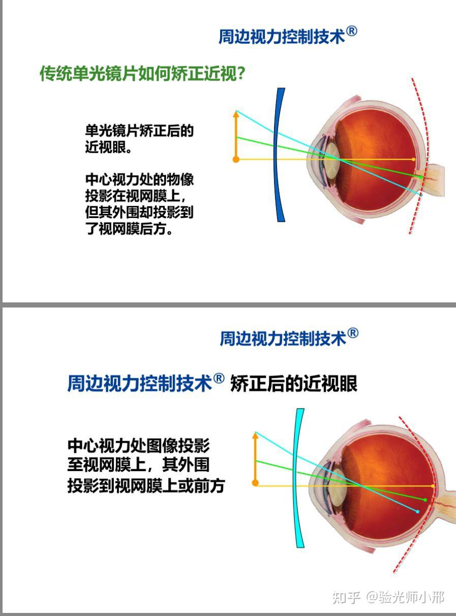 蔡司成长乐镜片周边视力控制技术,就是通过控制眼轴过快的生长发育