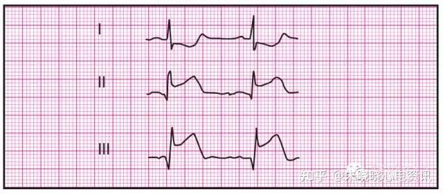 心房除极综合向量指向下(p波方向在下壁导联ii,iii,avf中向上)pr间期