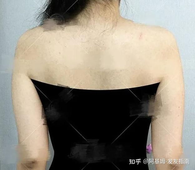 吸脂收费标准_吸脂费用怎么算_吸脂费用