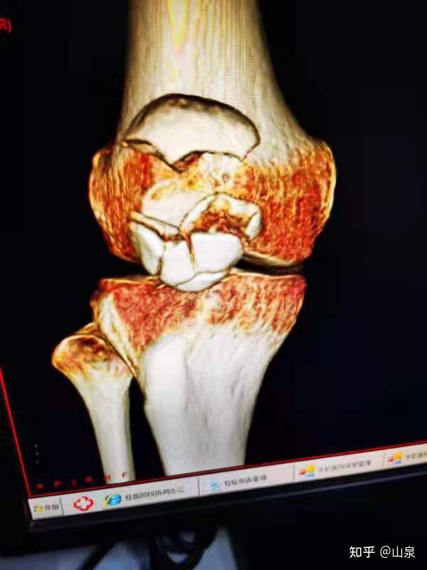 左髌骨粉碎性骨折图片图片