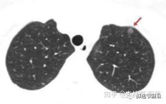 今天 我们来深入了解肺原位癌 知乎