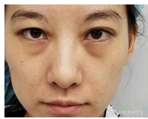 去眼袋前被同齡人叫阿姨痛下決心做了去眼袋填淚溝手術