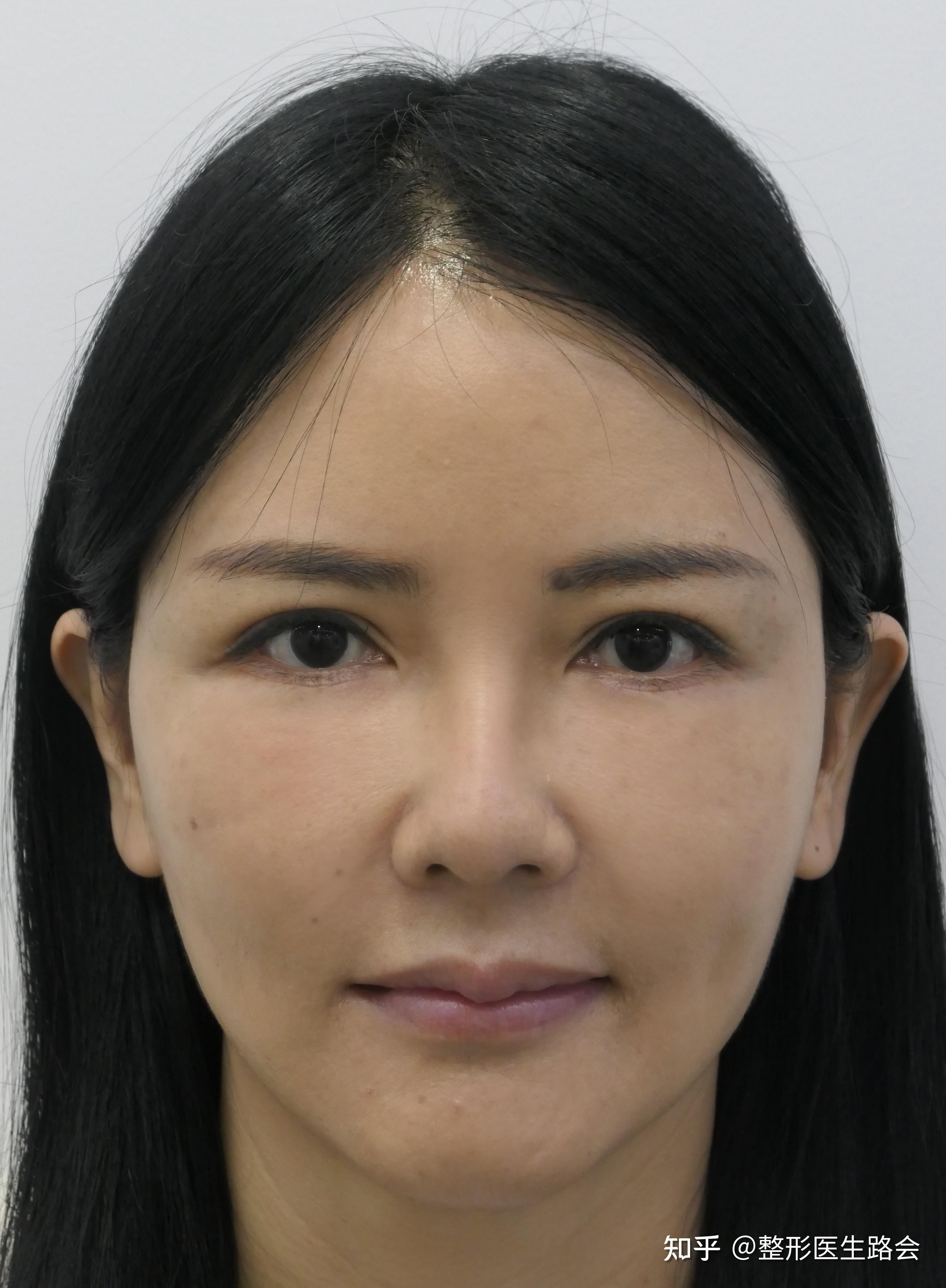 40多岁求美者自述:做【膨体】全脸整形经历和术后感受! - 知乎