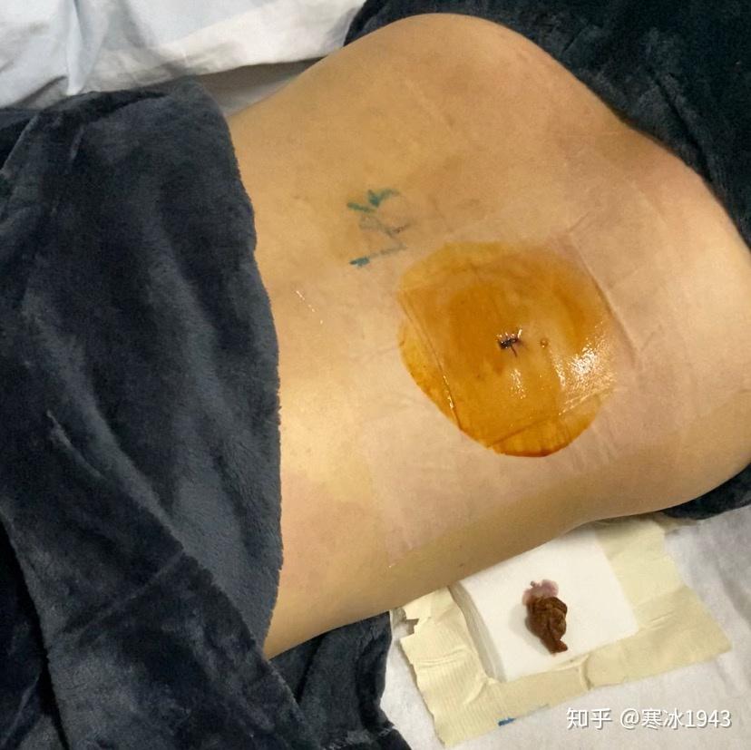 饱受三年腰间盘突出症折磨最终选择微创孔镜手术后的自述致永不复发