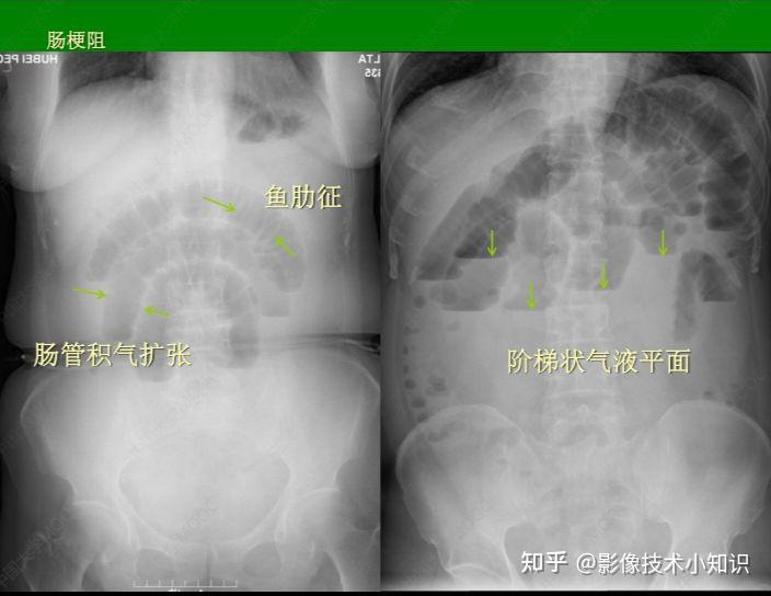 鱼肋征与阶梯状液平面图片