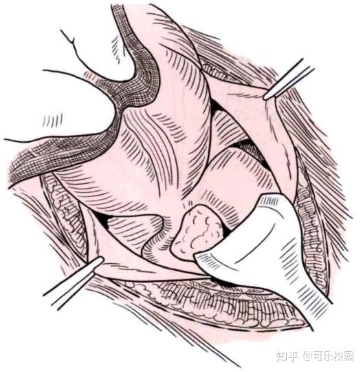 可先找升结肠,顺结肠带至回盲部,三条结肠带汇总处即是阑尾根部嗽在