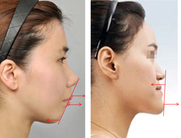 下巴颏前点,三点的连线呈一直线回头再来以e线和零子午线看看凸面型和