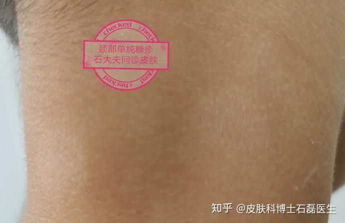 宝宝面部颈部白斑是虫斑白色糠疹白癜风无色素痣如何鉴别如何治疗