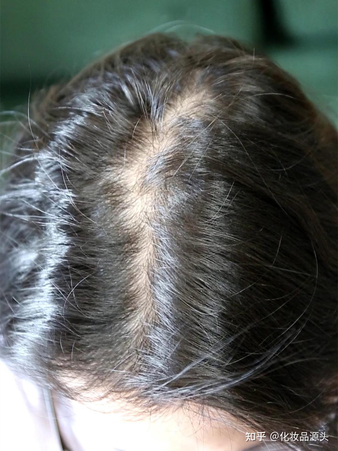00后都开始掉头发了,你慌了吗? - 知乎