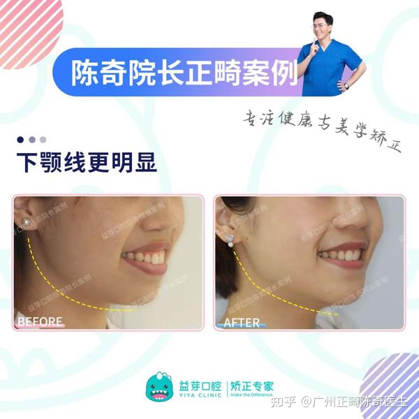 【正畸美学】揭秘“笑线”给笑容带来的变化！一起解锁自信笑容 - 知乎
