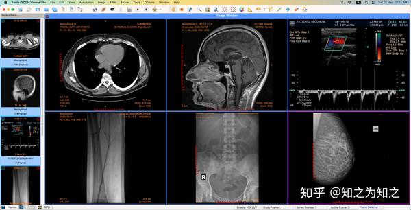 精简版 Sante DICOM Viewer Lite 医学阅片软件 |适用于Mac设备 - 知乎