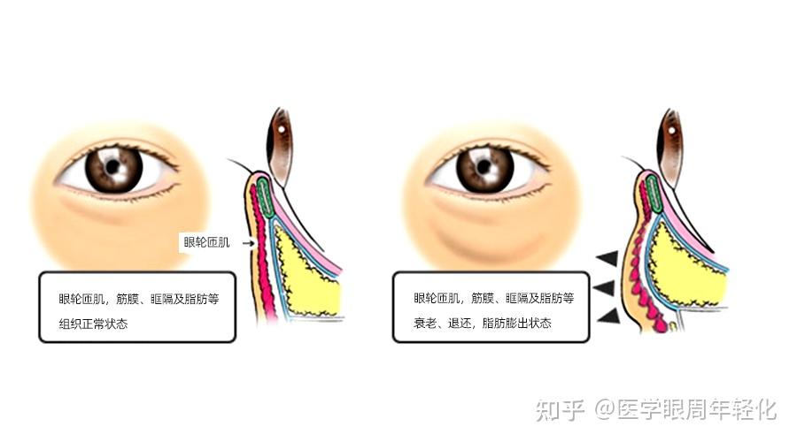 眼袋是怎么形成的?