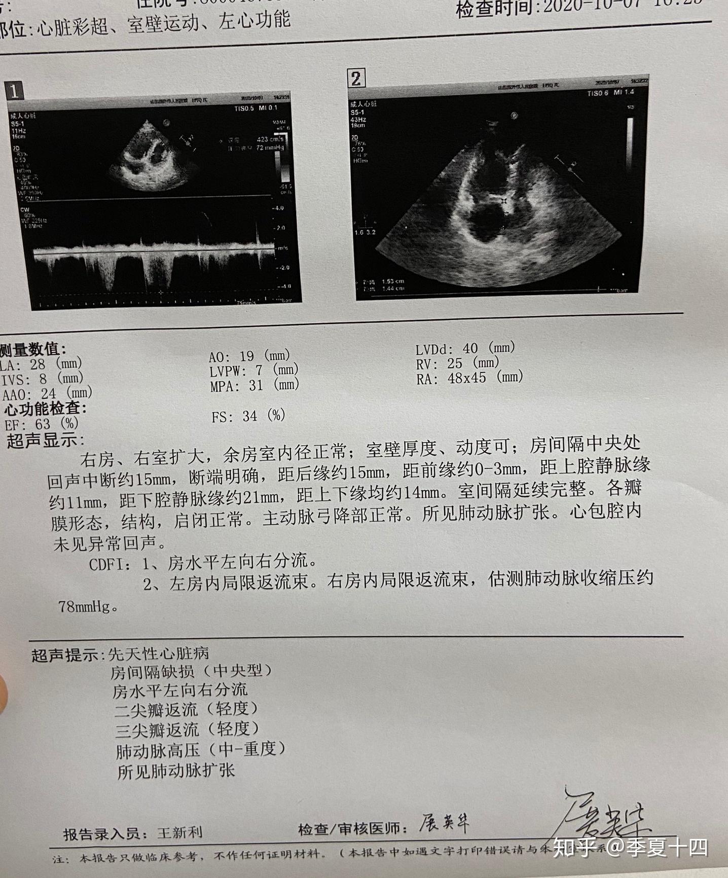 记录我的房缺手术经历