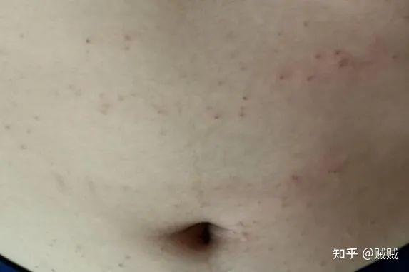 疥疮被误诊成湿疹,折腾了小半年的疥疮终于好了 - 知乎