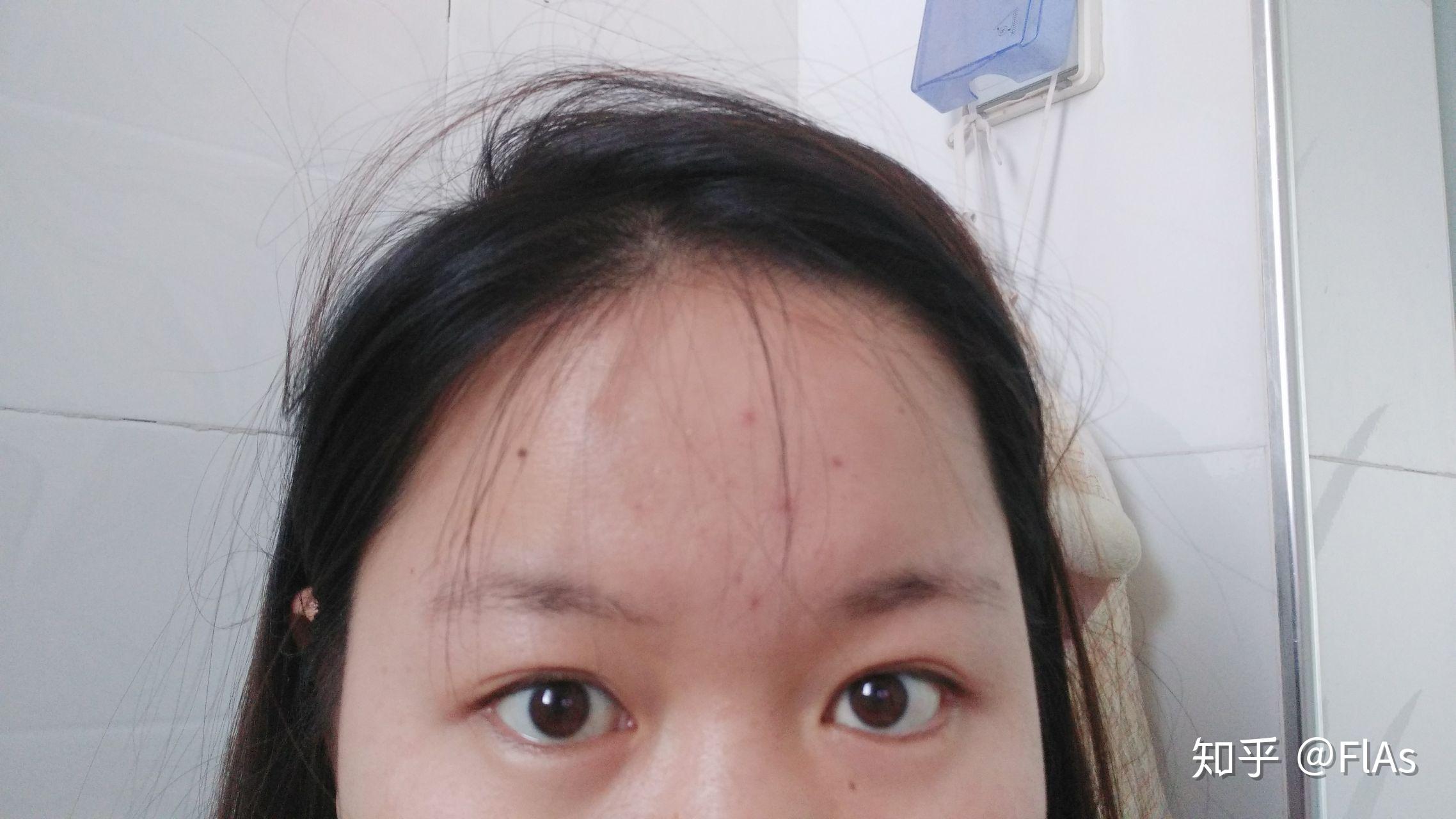 这个双眼皮需要修复吗