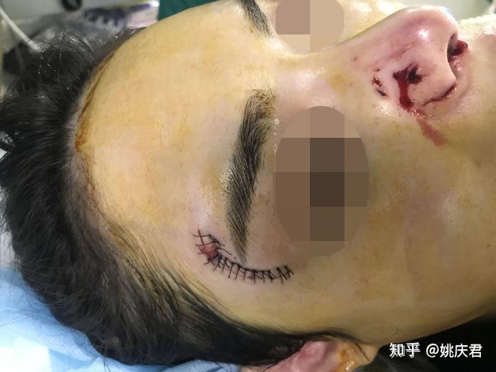 狗咬伤后 普外科缝合上图狗咬伤患者 美容缝合后拆线即刻那么,用小针
