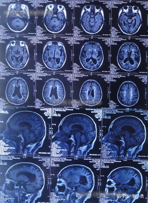 81岁老年脑积水腰大池分流术反致颅内感染颅内出血及走路不能2年余