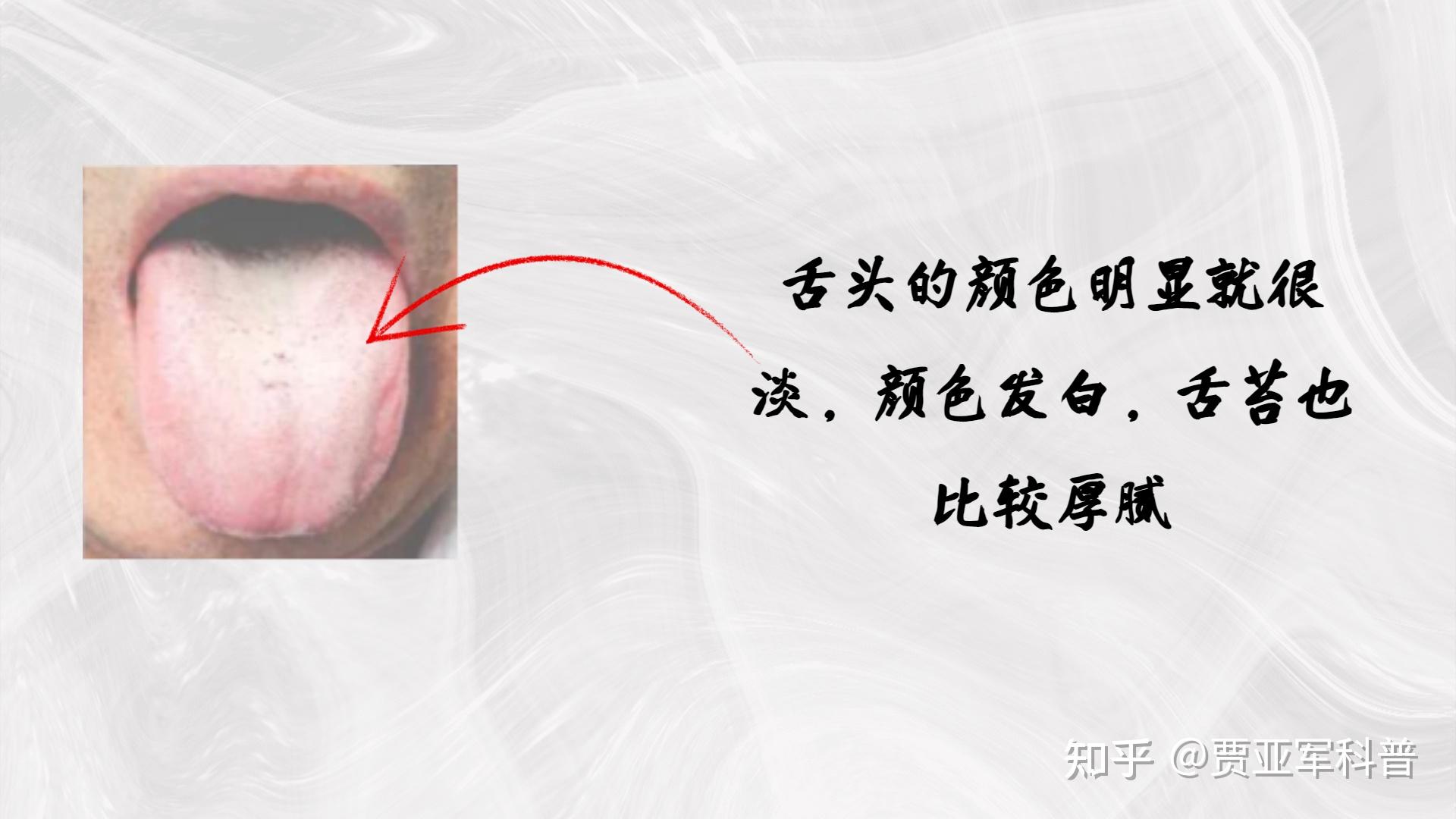 安成中醫: 中醫看舌頭到底在看什麼？(二) 舌苔 (下) ─苔質