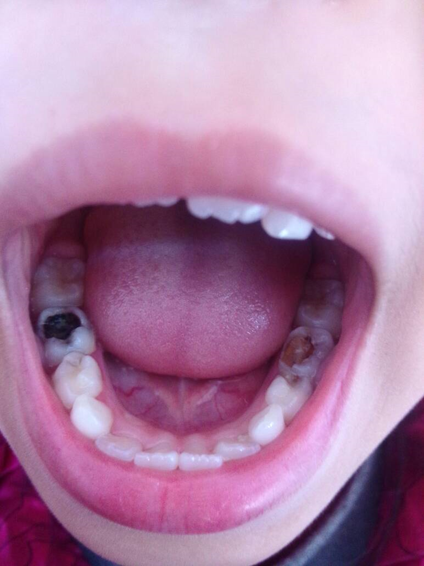 孩子蛀牙真头疼!怎么才能让孩子拒绝"假"刷牙?