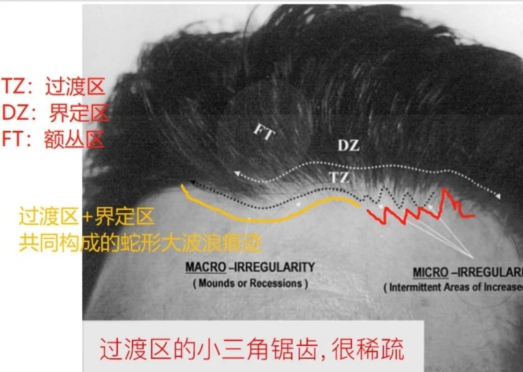 发际线植发必看!!发际线美学教你get原生感! - 知乎