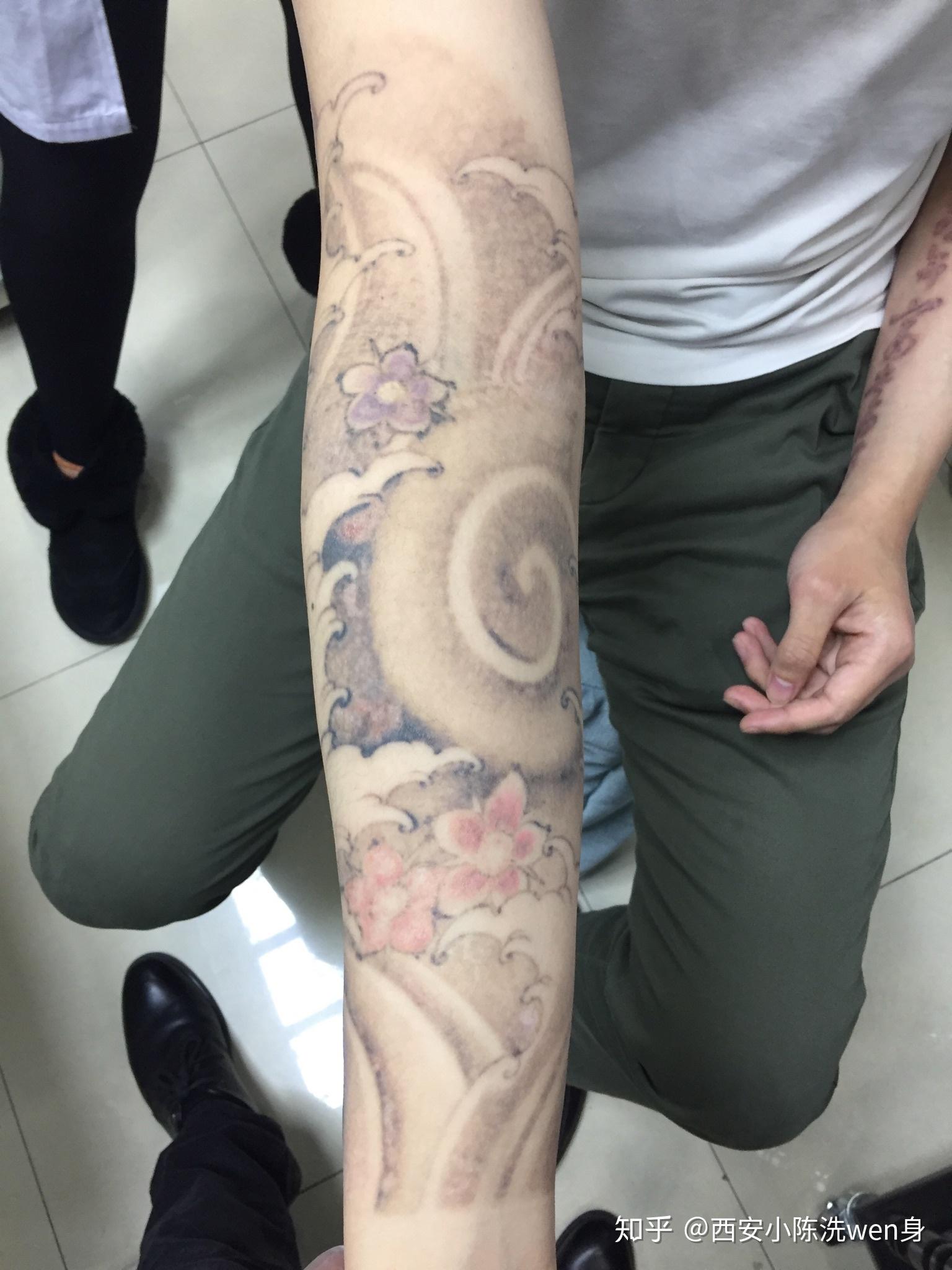 2020年可以洗掉满背纹身吗