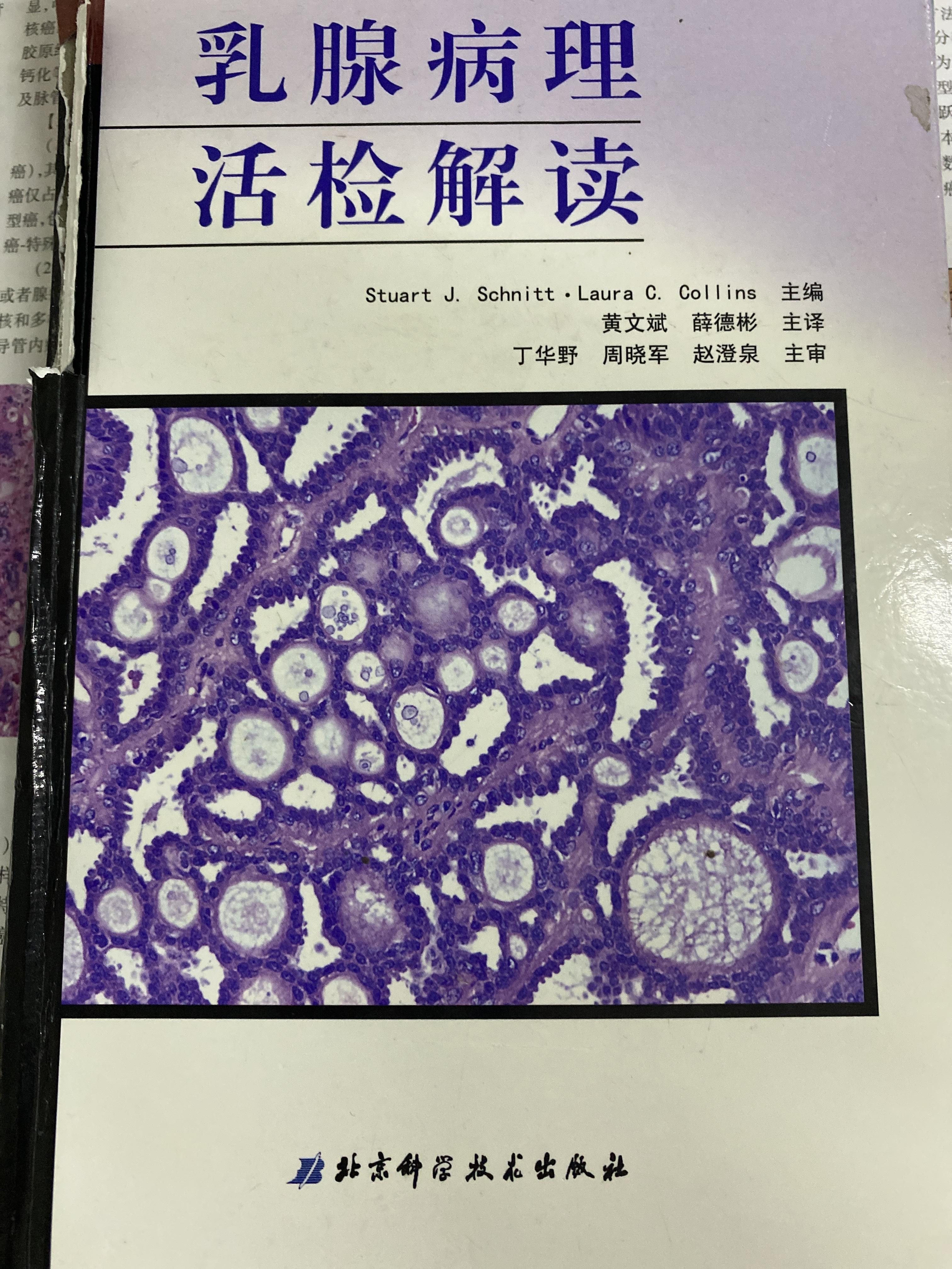 常见浸润性乳腺癌 - 知乎