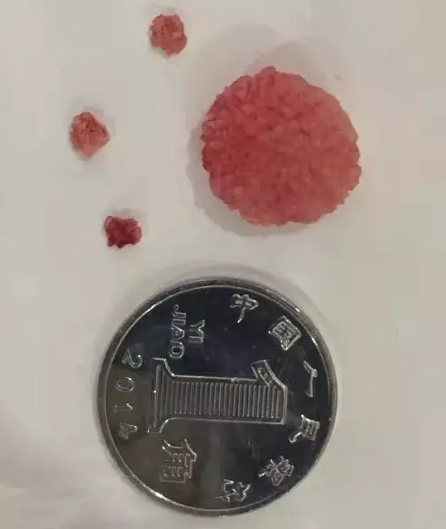 泌尿系统结石本文开头引起大家热烈讨论的那张x线片并不是什么芒果