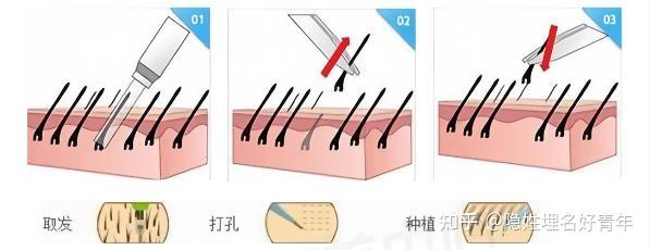 植发手术效果好不好？会二次加密吗？到底该不该植发呢？ - 知乎