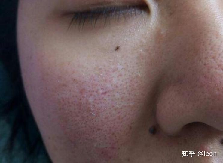 祛黑头收缩毛孔推荐学生党怎么去黑头收缩毛孔